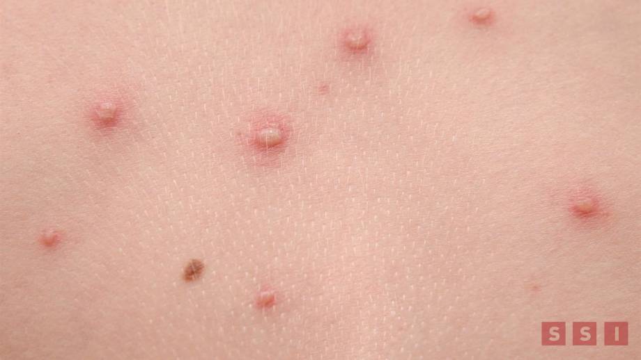 SUBE a cinco casos de viruela del mono en Chiapas; en el país hay una defunción - Susana Solis Informa